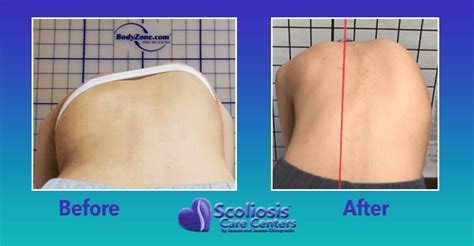 rib flare scoliosis|More.